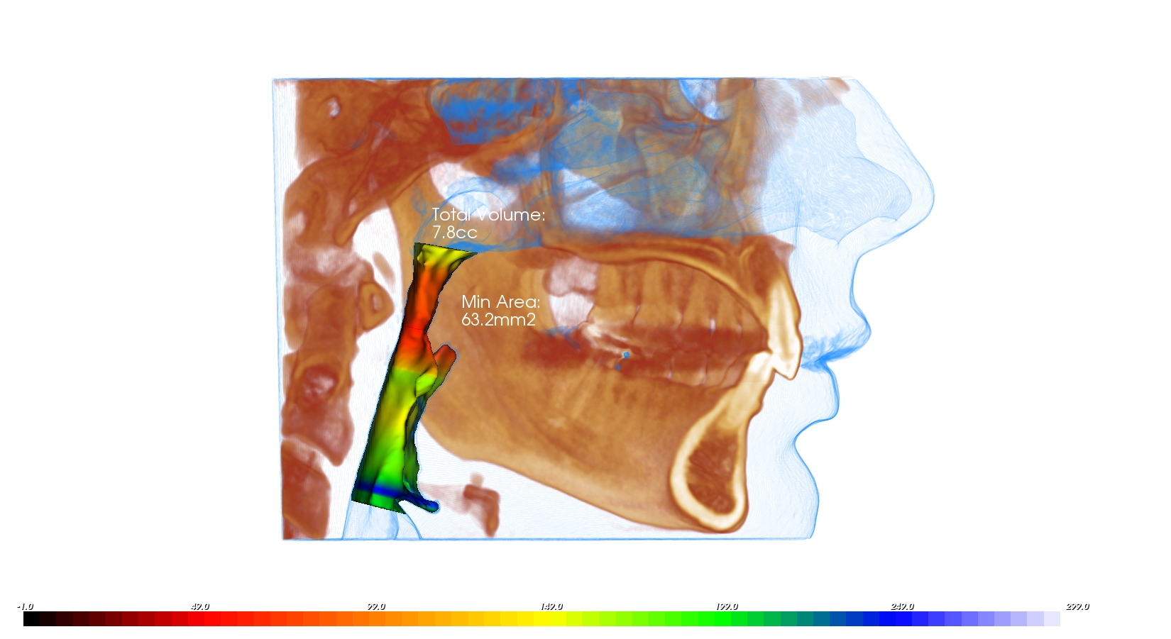 Obstructive Sleep Apnea Overview Signs Symptoms Terms And Treatments