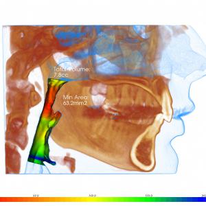 Obstructive Sleep Apnea Overview